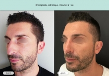 Cas n°11 résultat de rhinoplastie esthétique à un an de face de trois-quarts gauche