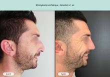 Cas n°11 résultat de rhinoplastie esthétique à un an de profil droit