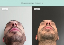 Cas n°11 résultat de rhinoplastie esthétique à un an de dessous