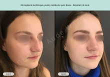 Cas n°12 résultat rhinoplastie esthétique à 3 mois de face de trois-quarts droit