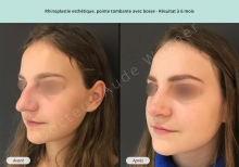 Cas n°12 résultat rhinoplastie esthétique à 3 mois de face de trois-quarts gauche