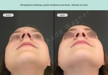 Cas n°12 résultat rhinoplastie esthétique à 3 mois de dessous