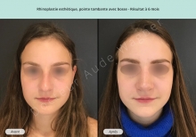 Cas n°12 résultat rhinoplastie esthétique à 3 mois de face