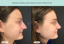 Cas n°12 résultat rhinoplastie esthétique à 3 mois de profil droit