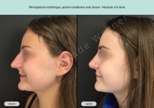 Cas n°12 résultat rhinoplastie esthétique à 3 mois de profil gauche