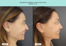 Cas n°13 résultat avant après de rhinoplastie ou chirurgie esthétique du nez à ToulouseCas n°13 résultat avant après de rhinoplastie ou chirurgie esthétique du nez à Toulouse