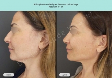 Cas n°13 résultat avant après de rhinoplastie ou chirurgie esthétique du nez à 1 an à Toulouse