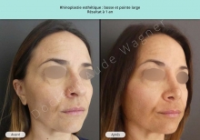 Cas n°13 avant après de rhinoplastie esthétique à Toulouse