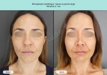 Cas n°13 résultat avant après de rhinoplastie esthétique face à 1 an à Toulouse