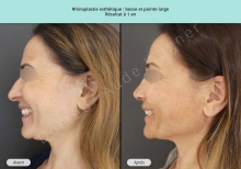 Cas n°13 avant après de rhinoplastie ou chirurgie esthétique du nez à Toulouse