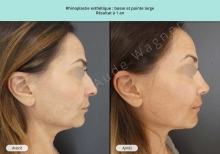 Cas n°13 résultat av ap de rhinoplastie ou chirurgie esthétique du nez à 1 an à Toulouse