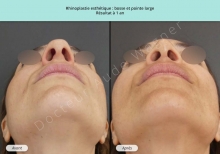 Cas n°13 résultat av ap de rhinoplastie ou chirurgie esthétique du nez à Toulouse