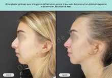 Cas n°14 resultat avant après de rhinoplastie à Toulouse