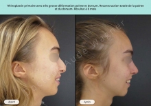 Cas n°14 resultat av ap de rhinoplastie à Toulouse