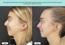 Cas n°14 resultat avant après de rhinoplastie ou chirurgie esthétique du nez à Toulouse