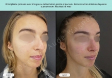 Cas n°14 resultat av ap de rhinoplastie esthétique à Toulouse