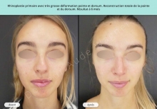 Cas n°14 resultat avant après de rhinoplastie esthétique à Toulouse