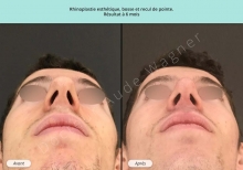 Cas n°15 resultat av ap de rhinoplastie à Toulouse