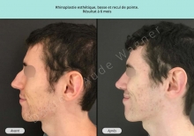 Cas n°15 resultat avant après de rhinoplastie à Toulouse