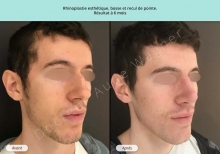 Cas n°15 resultat av ap de rhinoplastie esthétique à Toulouse