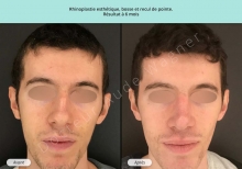 Cas n°15 resultat avant après de rhinoplastie esthétique à Toulouse