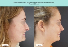 Cas n°16 resultat av ap de rhinoplastie à Toulouse