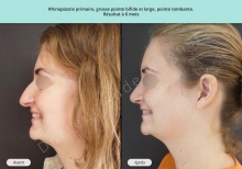 Cas n°16 resultat avant après de rhinoplastie ou chirurgie esthétique du nez à Toulouse