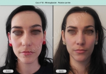 Résultat rhinoplastie, chirurgie de la pointe carrée du nez