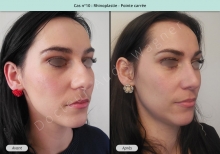 Résultat rhinoplastie, chirurgie de la pointe carrée du nez