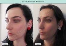 Résultat rhinoplastie, chirurgie de la pointe carrée du nez