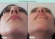Résultat rhinoplastie, chirurgie de la pointe carrée du nez