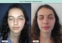 Résultat rhinoplastie, affinement de la pointe du nez