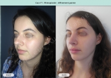 Résultat rhinoplastie, affinement de la pointe du nez