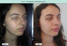 Résultat rhinoplastie, affinement de la pointe du nez