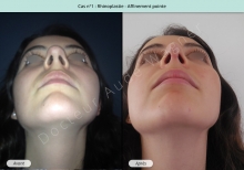 Résultat rhinoplastie, affinement de la pointe du nez