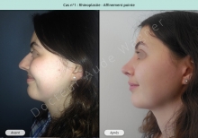 Résultat rhinoplastie, affinement de la pointe du nez