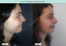 Résultat rhinoplastie, affinement de la pointe du nez