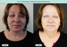 Résultat rhinoplastie, affinement de la pointe et petite bosse du nez