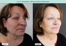 Résultat rhinoplastie, affinement de la pointe et petite bosse du nez