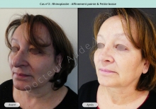 Résultat rhinoplastie, affinement de la pointe et petite bosse du nez