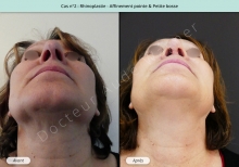 Résultat rhinoplastie, affinement de la pointe et petite bosse du nez