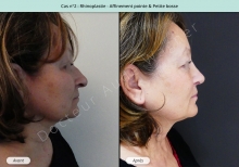 Résultat rhinoplastie, affinement de la pointe et petite bosse du nez