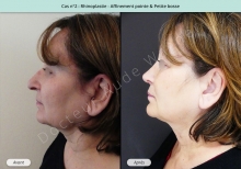 Résultat rhinoplastie, affinement de la pointe et petite bosse du nez