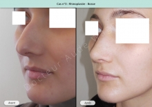 Résultat rhinoplastie, chirurgie de la bosse du nez