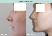 Résultat rhinoplastie, chirurgie de la bosse du nez