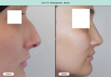 Résultat rhinoplastie, chirurgie de la bosse du nez