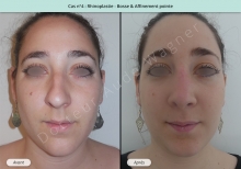 Résultat rhinoplastie, chirurgie de la bosse du nez et affinement de la pointe