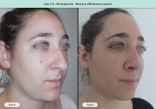 Résultat rhinoplastie, chirurgie de la bosse du nez et affinement de la pointe