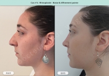 Résultat rhinoplastie, chirurgie de la bosse du nez et affinement de la pointe