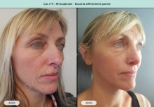 Résultat rhinoplastie, chirurgie de la bosse du nez et affinement de la pointe